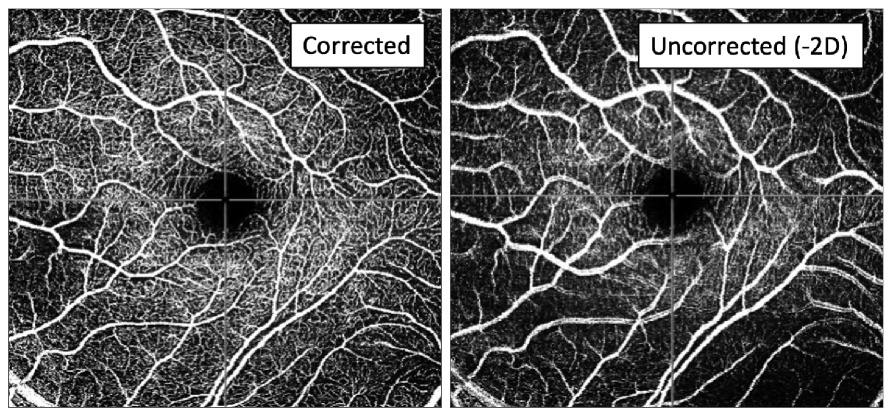 OCT-A of the superficial vascular plexus with and without correction of -2D cyl shows less definition of capillaries and increased diameter of large retinal vessels induced by astigmatism.