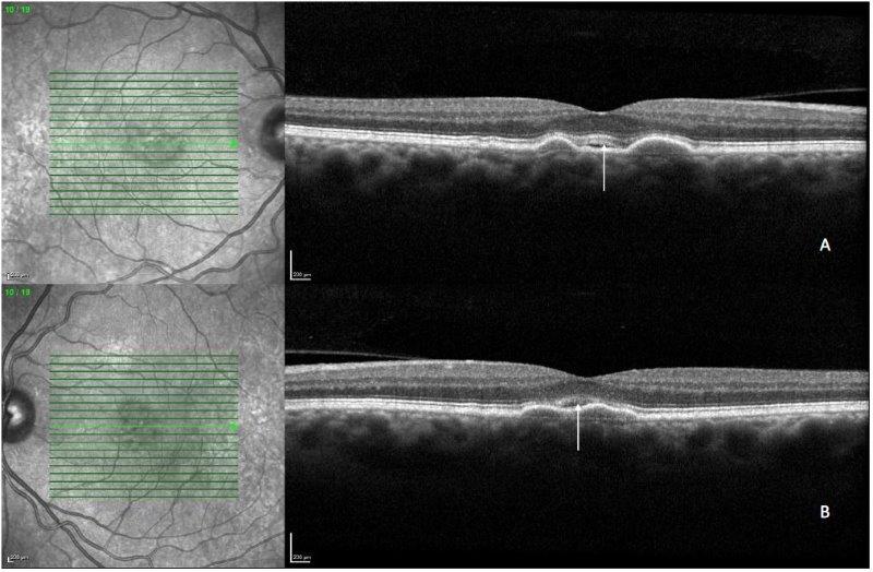 A definitive diagnosis of this new AMD variant is key. Experts recommend a complete evaluation with multimodal imaging to rule out other causes. Differentials include conventional types of MNV, retinal vascular abnormalities such as diabetic macular edema and retinal occlusive vascular diseases, and other conditions such as intraretinal degenerative pseudocysts, ePVAC and MacTel 2.