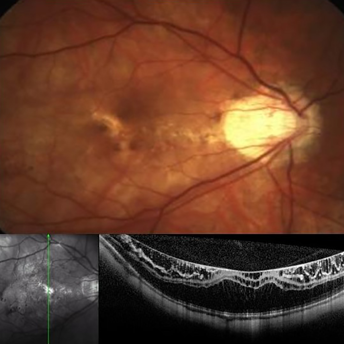 The predominant pattern of advancement manifested in these pediatric myopes as the enlargement of diffuse atrophy, constituting more than half of the reported cases.