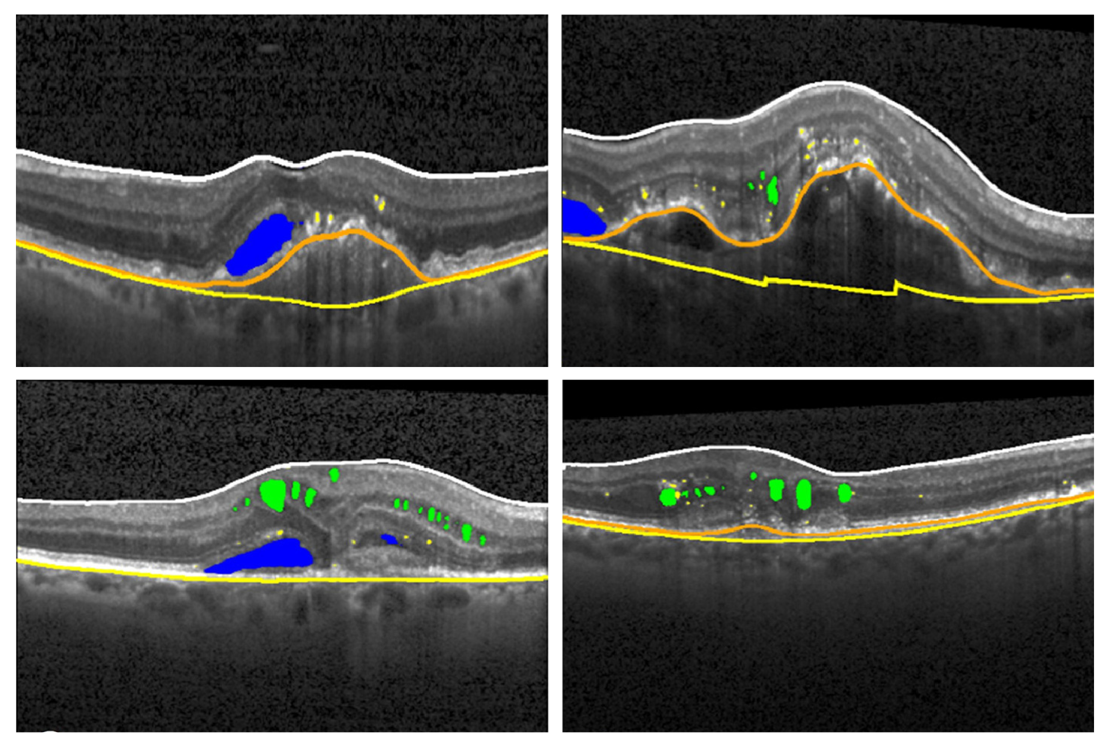 Top row:  non-polypoidal MNV1, polypoidal MNV1. Bottom row: MNV2, MNV3. The researchers used AI tools to isolate fluid biomarkers in each MNV form as follows: • Cystic intraretinal fluid = green • subretinal fluid = blue • hyperreflective foci = yellow • pigment epithelial detachment = orange line • Bruch´s membrane = yellow line • retinal thickness = ILM (white line) to RPE (orange line).