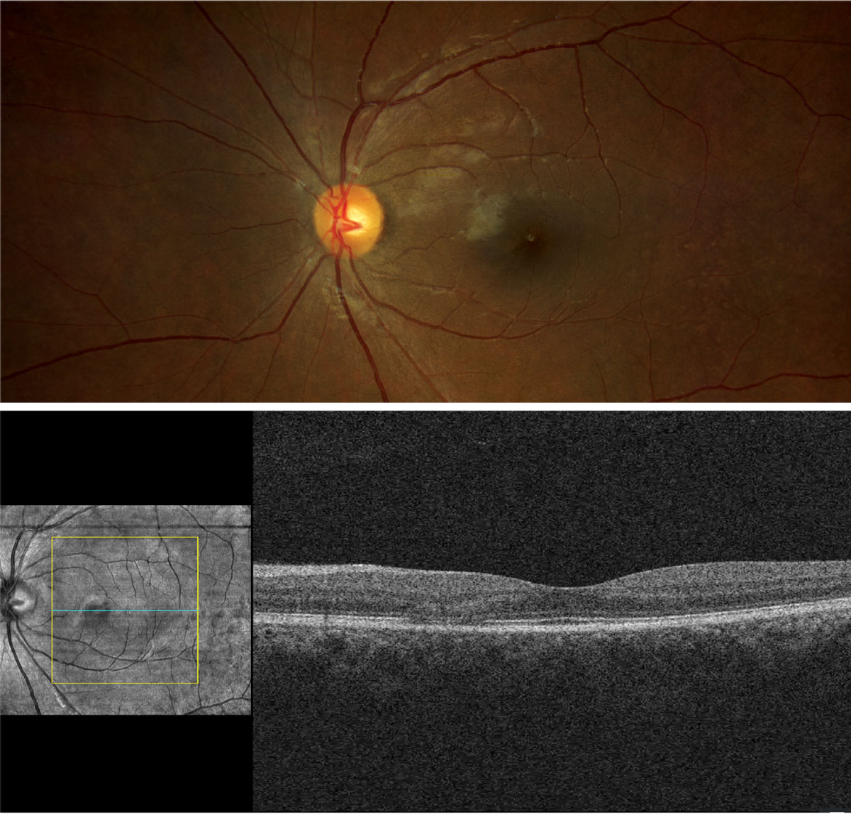 Does the appearance of the retina confirm any suspicions raised by the case history?