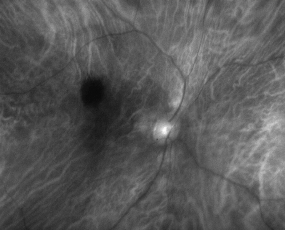 Choroidal nevus in the right eye from a different patient that corresponds quite closely to the description and sketch documented by the first eye clinician.