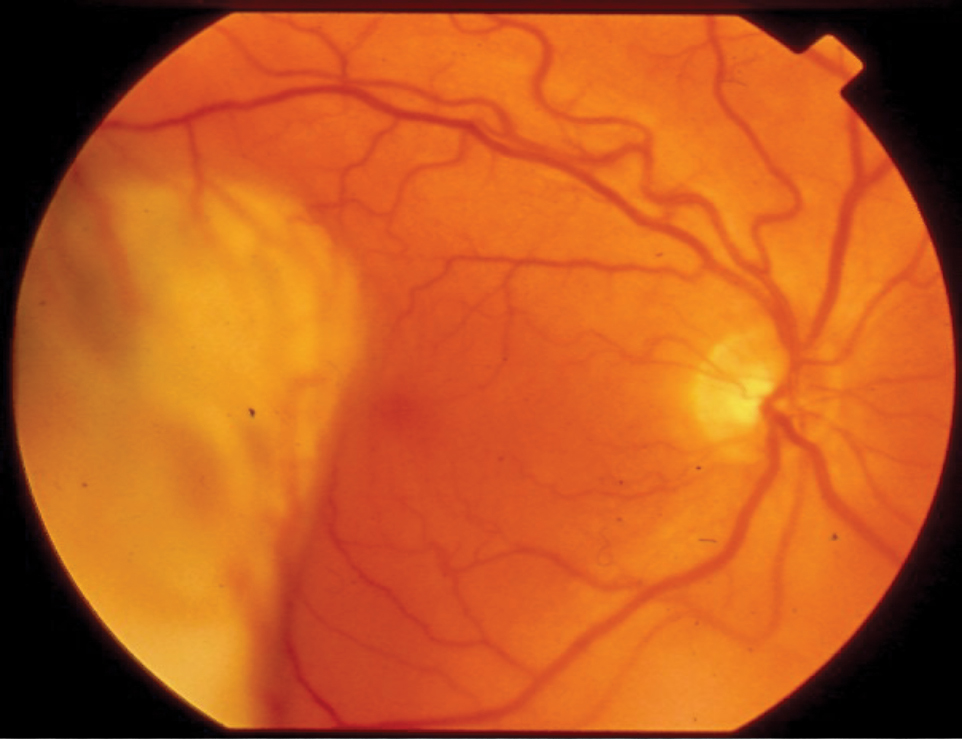 The actual fundus photo of the patient’s right eye taken that same day that patient was seen by the retinologist.