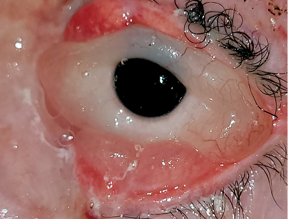 Conjunctival chemosis