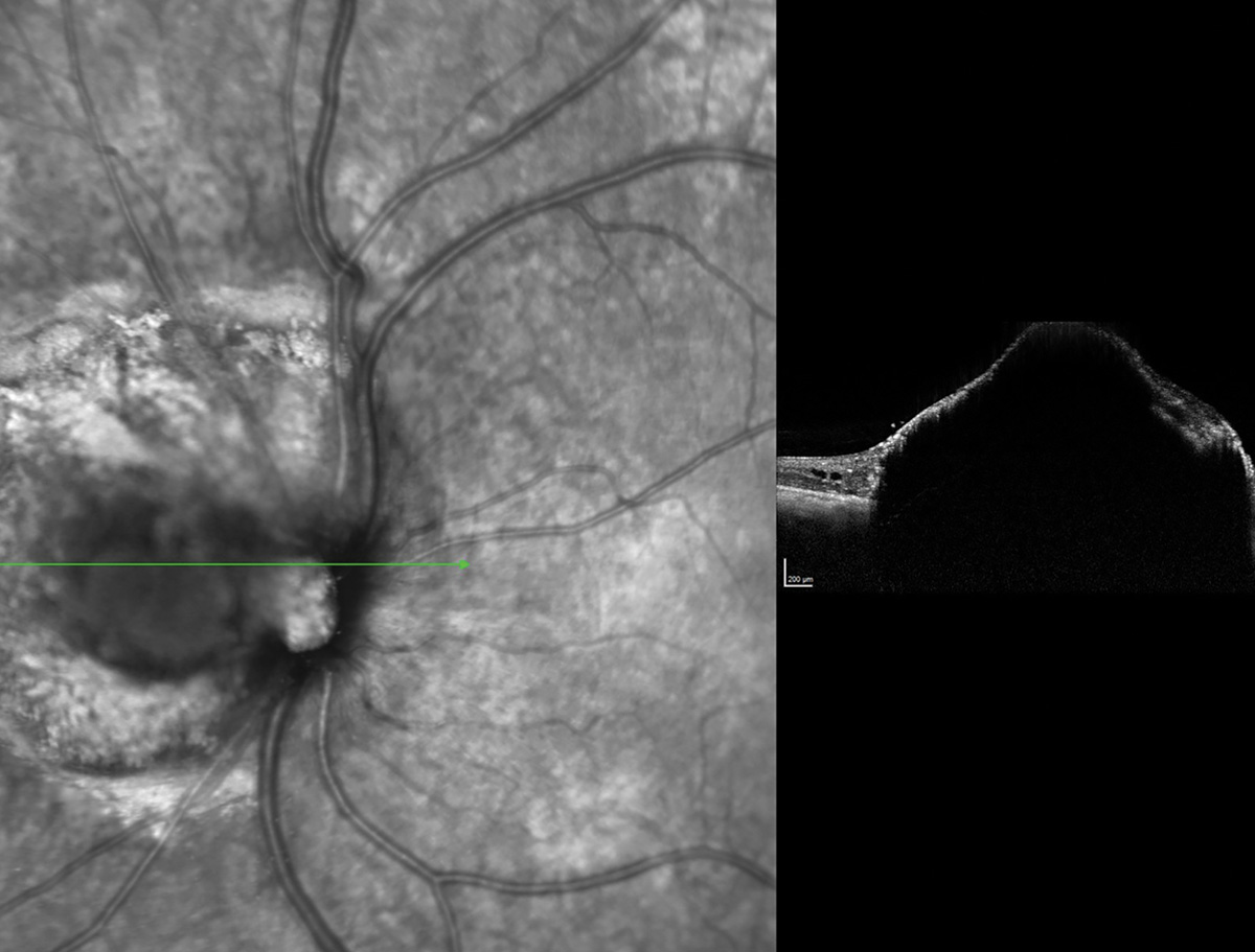 Optic nerve melanocytoma