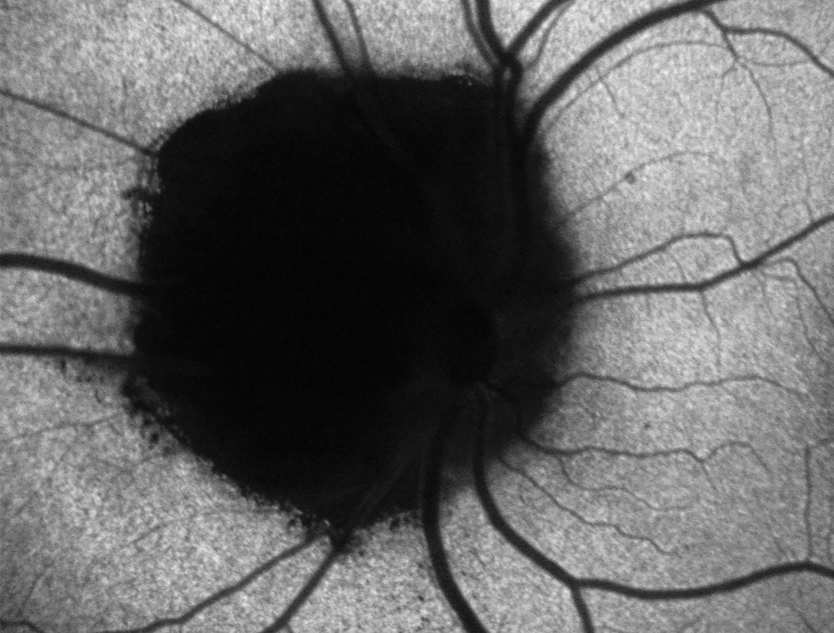 Optic nerve melanocytoma