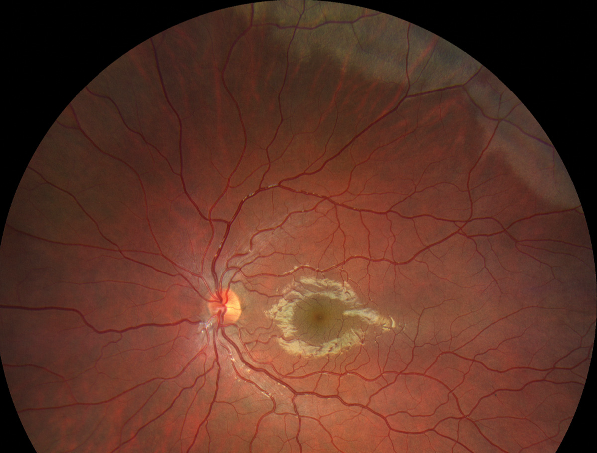 Commotio retinae