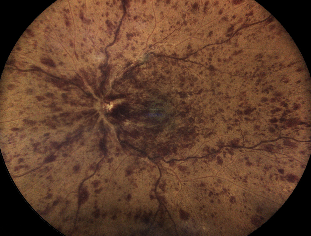 Central retinal vein occlusion