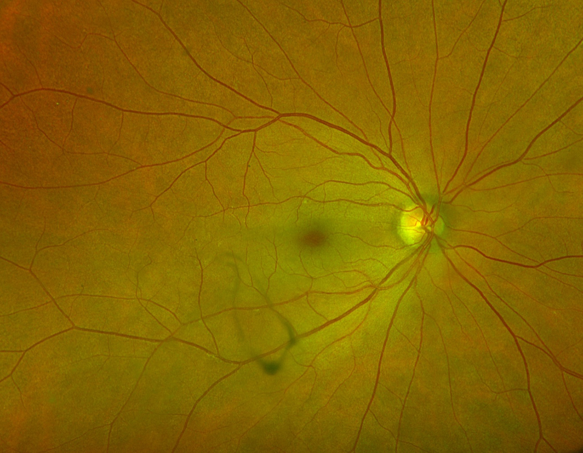Central retinal artery occlusion