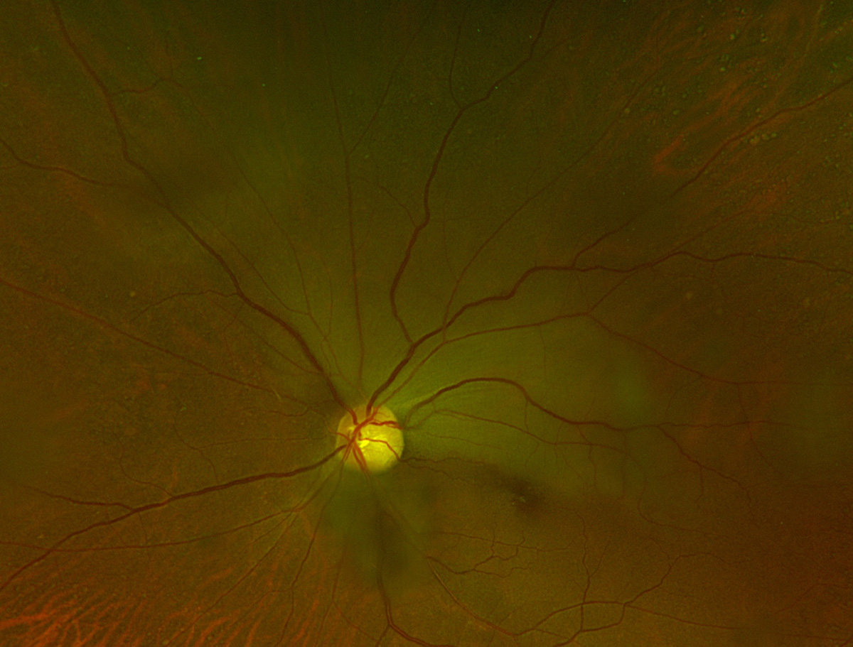 Branch retinal artery occlusion
