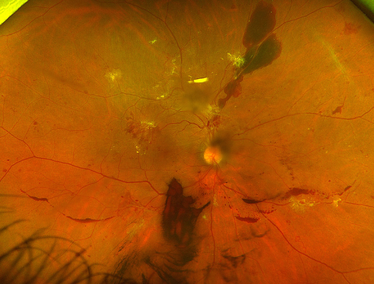 Proliferative diabetic retinopathy