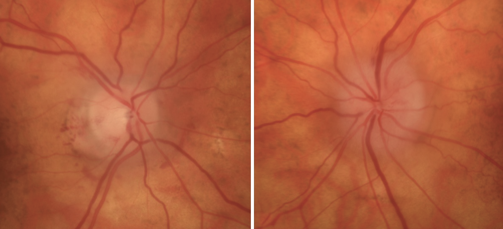 Fig. 1. Right (left) and left (right) optic nerves. The right nerve was pallid with resolving edema, and the left nerve was slightly pallid with significant edema. These clinical pictures support the time frame of the patient’s vision loss.