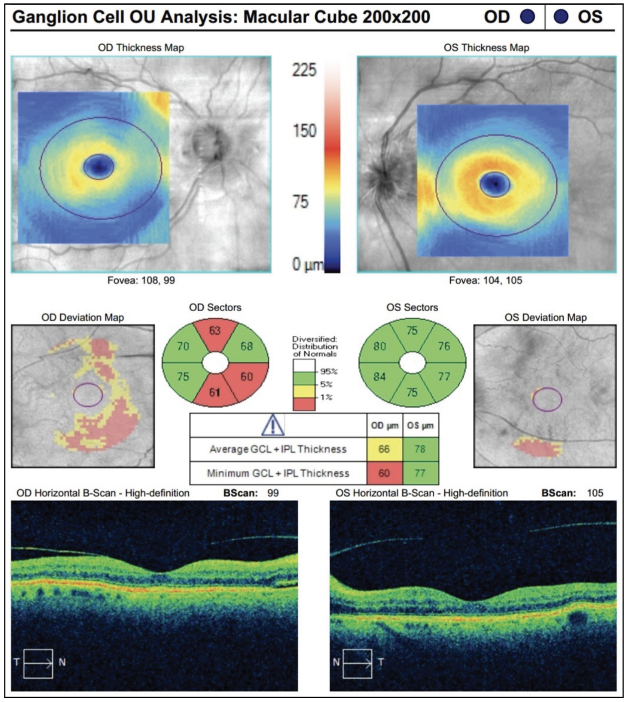 Fig. 2. The patient’s OCT ganglion cell analysis reveals early thinning in the right eye but a normal study in the left.