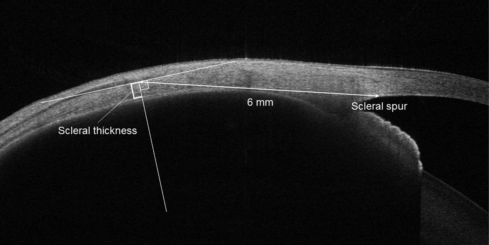 Researchers observed that complex central serous chorioretinopathy cases were more significantly associated with scleral thickening (measured here using anterior segment OCT), persistent subretinal fluid, outer retinal atrophy and intraretinal fluid.