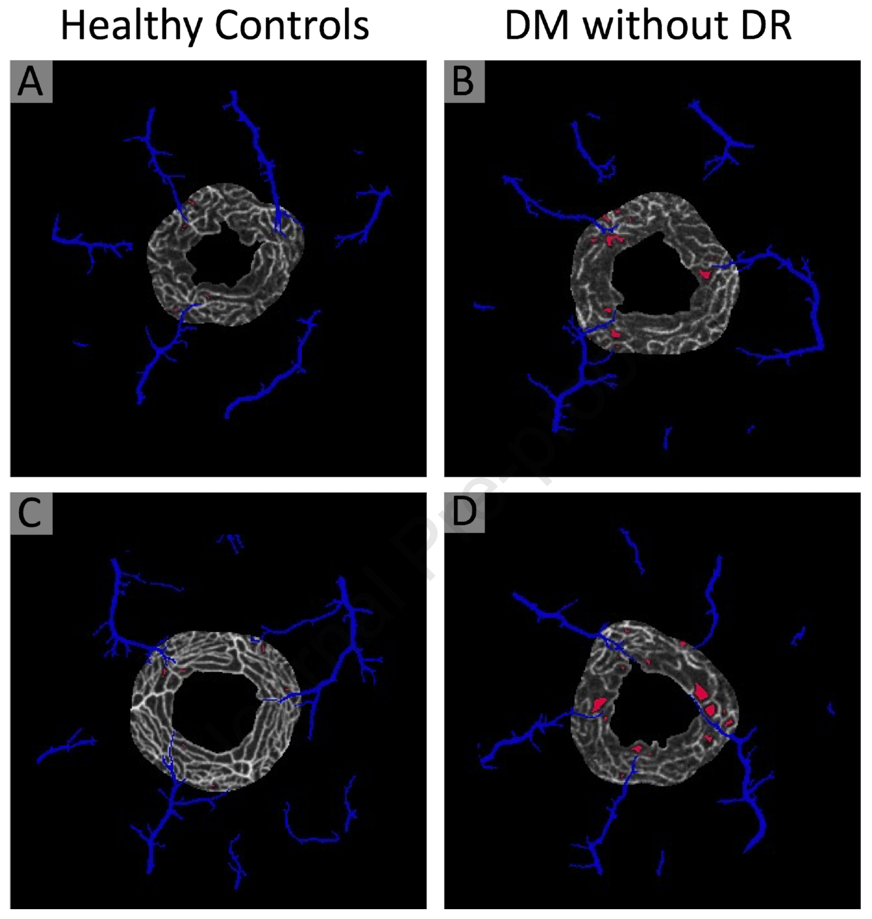 OCT angiography of patients with diabetes without diabetic retinopathy showed macular perfusion deficits were significantly increased in the perivenular deep capillaries (shown in red) compared to healthy controls. 