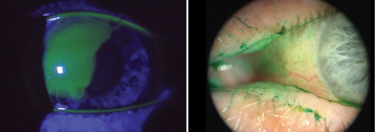 Fig. 10. The use of vital dyes is imperative when assessing the ocular surface for signs of infection, trauma, surface abnormalities among others. Using the cobalt blue filter in conjunction with sodium fluorescein will highlight certain corneal abnormalities. Lissamine green tends to highlight dead and degenerating cells. It will also easily adhere to mucus strands and filaments and even show advanced conjunctival staining in dry eye patients.
