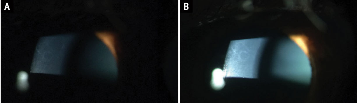 Fig. 3. ABMD in (a) dim illumination and (b) bright illumination at the slit lamp.