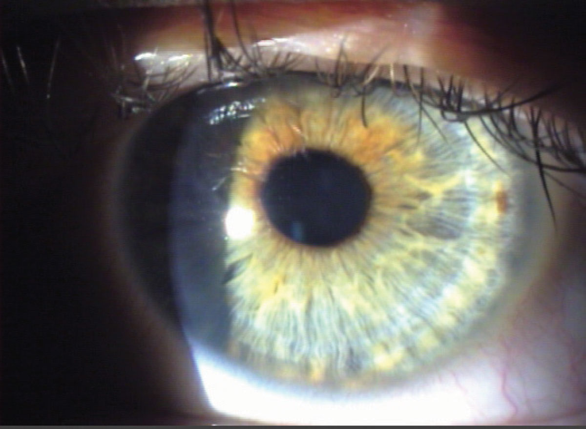 Fig. 4. Diffuse illumination allows for a broad overview of the eye rather than fine details.