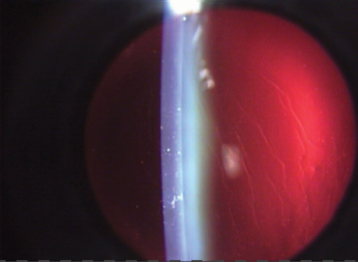 Fig. 9. Retroillumination from the fundus will highlight different corneal changes.