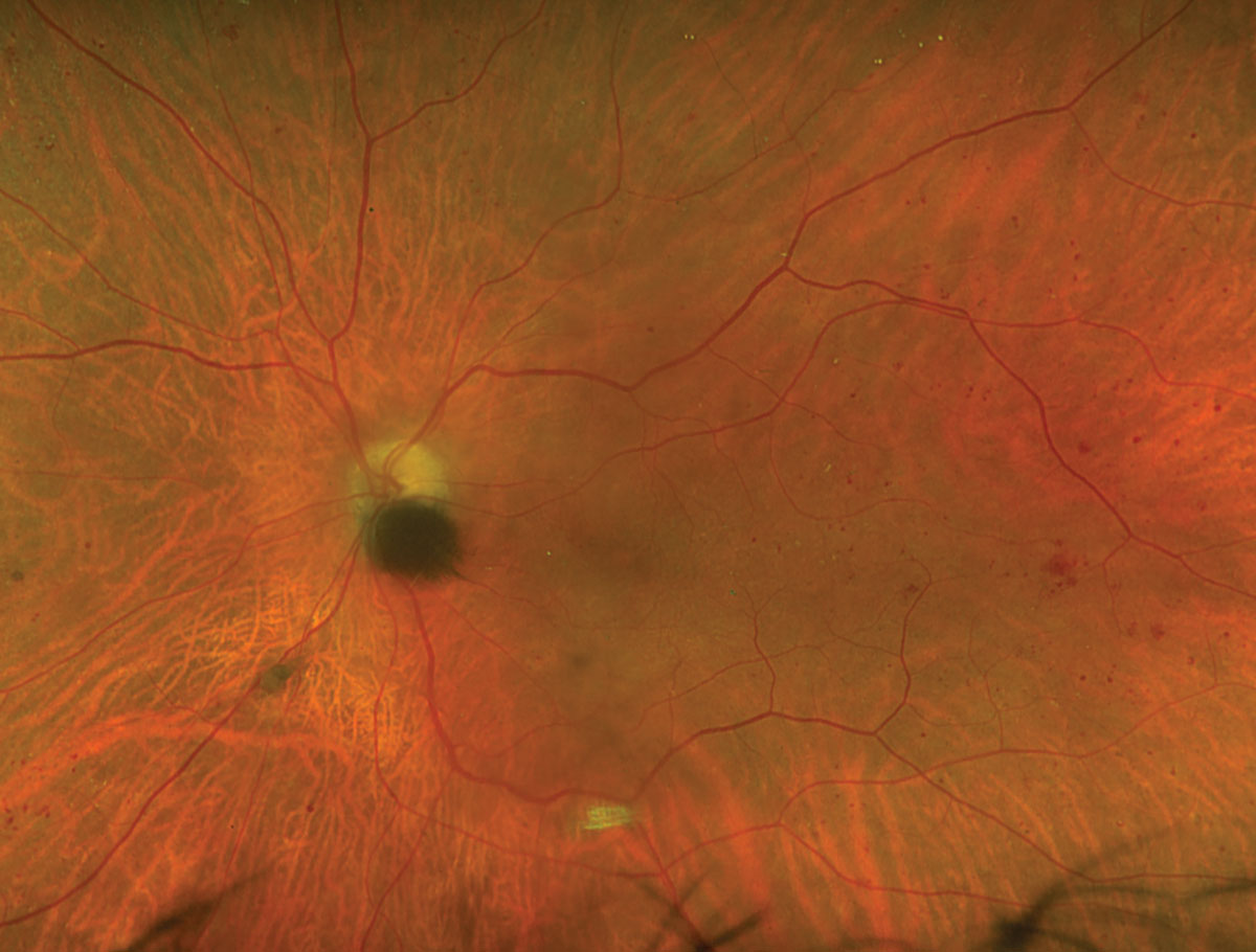 Fig. 1. Optos fundus photograph of the left eye.