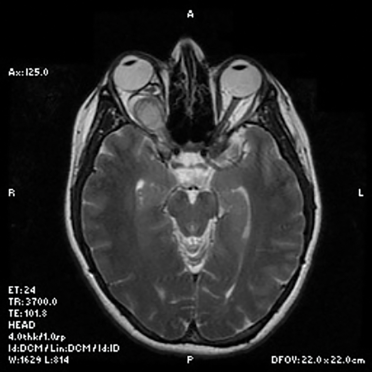 Axial MRI section through the orbital mass OD (on the left) and the normal optic nerve OS (on the right).