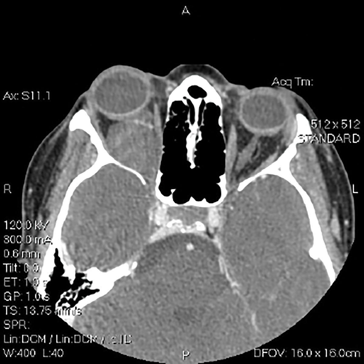 Axial CT section at the same level as the previous image.