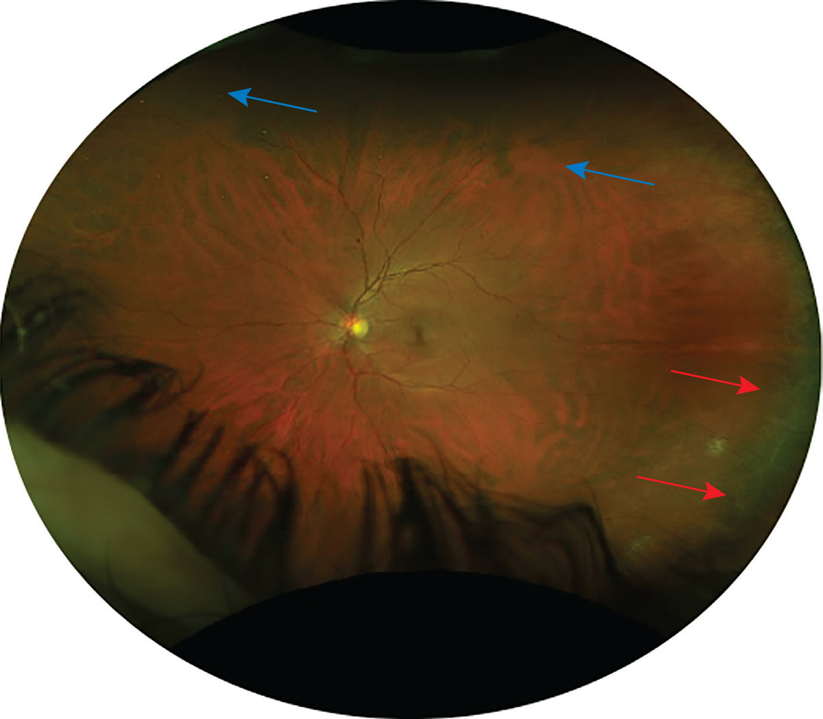 Fig. 2. This Optos photo shows an area of ora serrata at temporal retina (marked by red arrows) and the mid-peripheral vortex veins (marked by blue arrows). 