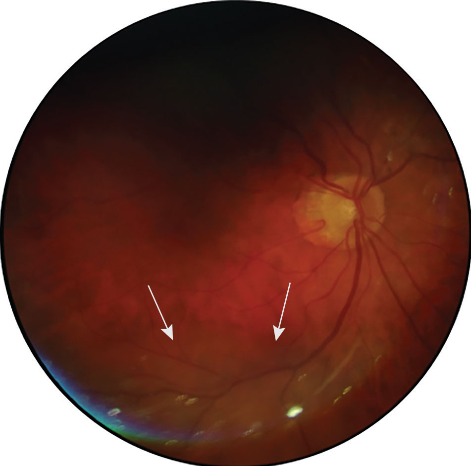Fig. 7. A traditional fundus photo capturing an elevated area within the inferior retina of the posterior pole in the right eye (marked by white arrows).
