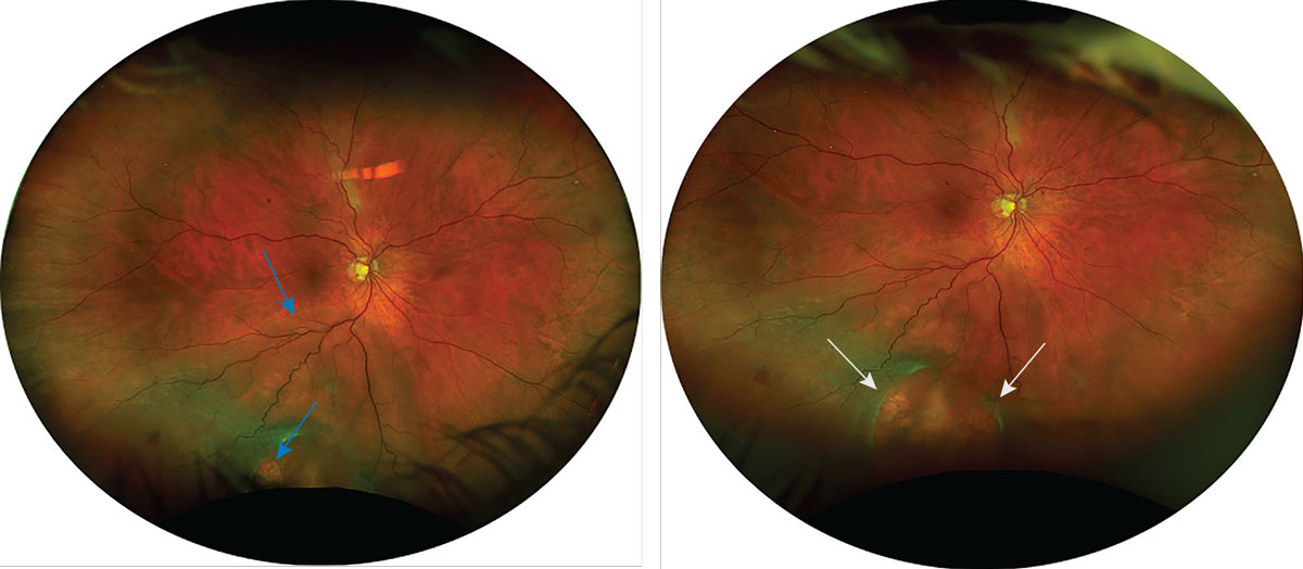 Fig. 9. This Optos photo captures a retinal detachment that could not be fully seen in Figure 7. The left photo was captured in primary gaze and shows an inferior retinal detachment with at least one retinal break (marked by blue arrows). The right photo was captured with inferior steering and shows two large retinal breaks (marked by white arrows) that could not be fully seen in primary gaze.
