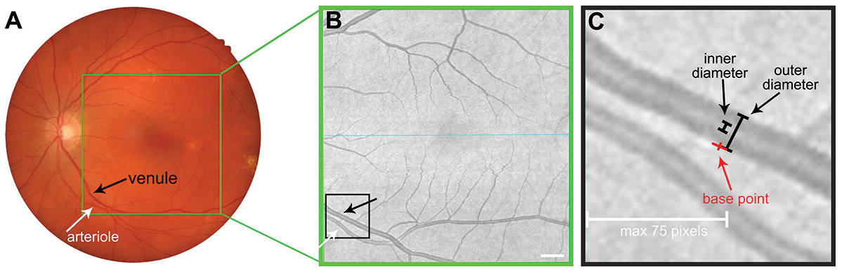 These images from the study show how (A) fundus photography and (B) corresponding en face OCT images were used to identify the largest arteriole and venule closest to the optic nerve head. (C) The outer and inner diameters of each vessel were then measured.