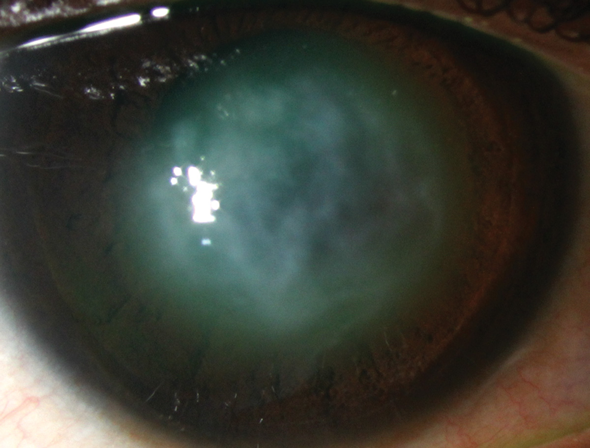 Despite the challenges of obtaining data through edematous corneas, the researchers still recommend routine corneal tomography to assess changes over time in eyes after hydrops.