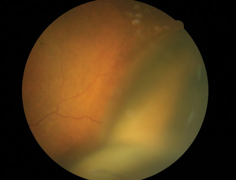 Systemic steroids treatment after suprachoroidal hemorrhage were associated with better change in vision, final vision and anatomic success.