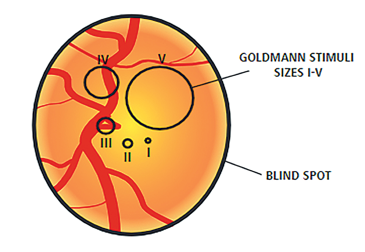 Goldmann size II allowed for better correlations between VF data and the corresponding macular GCL thickness when evaluating the relationship between the less affected nasal VF and temporal macular parameters. 