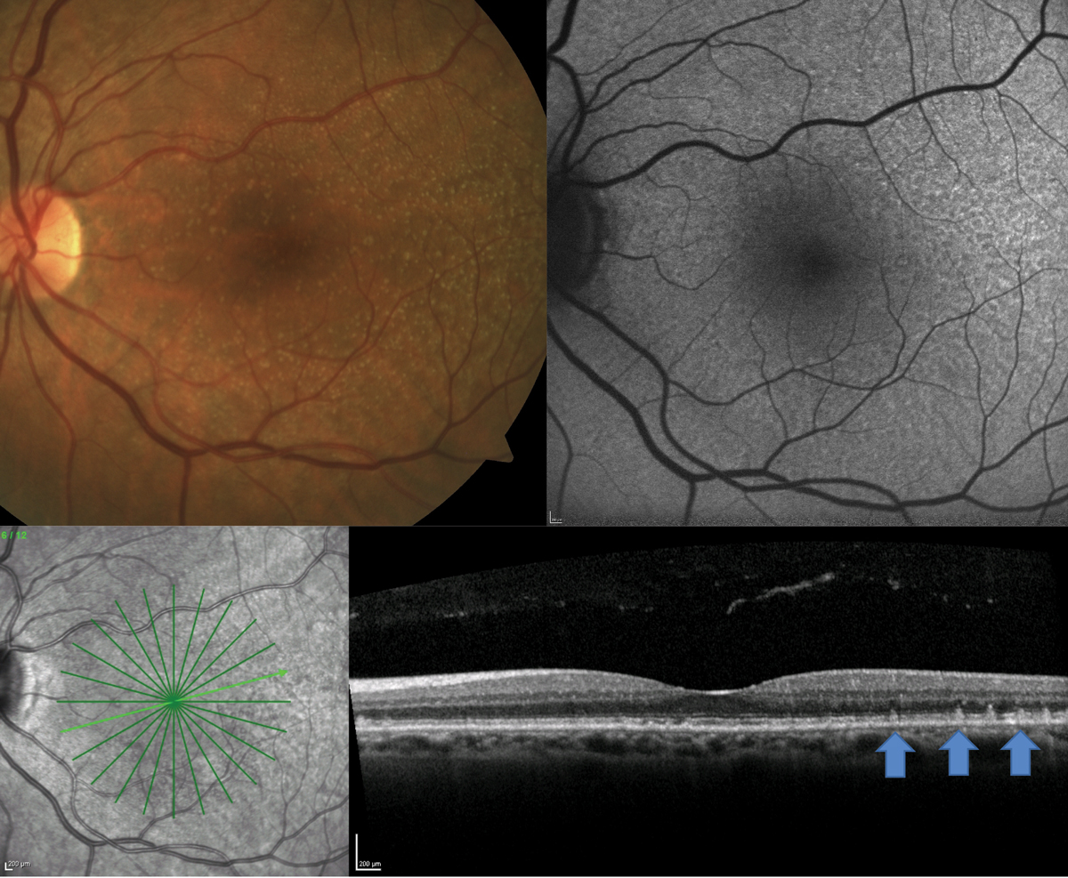 A patient with clinically visible small- to medium-sized drusen shows presence of RPD on FAF and OCT.