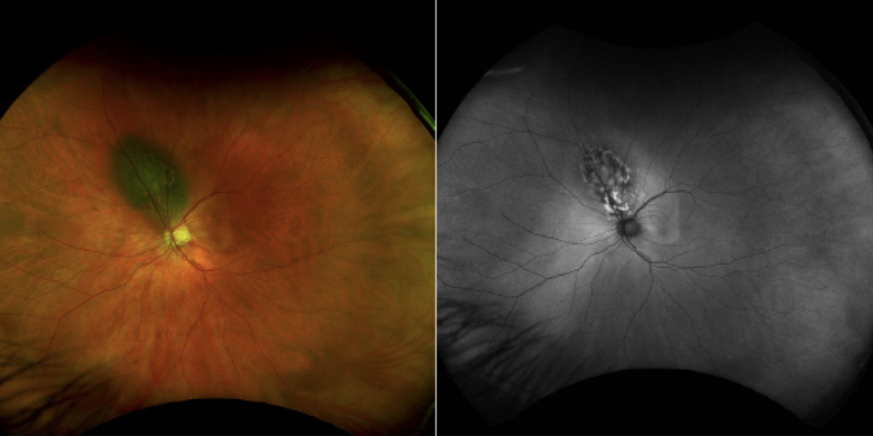A 57-year-old Caucasian male presented with acute complaints of blurry vision in the left eye. His ocular history was unremarkable with last dilated exam the year prior.