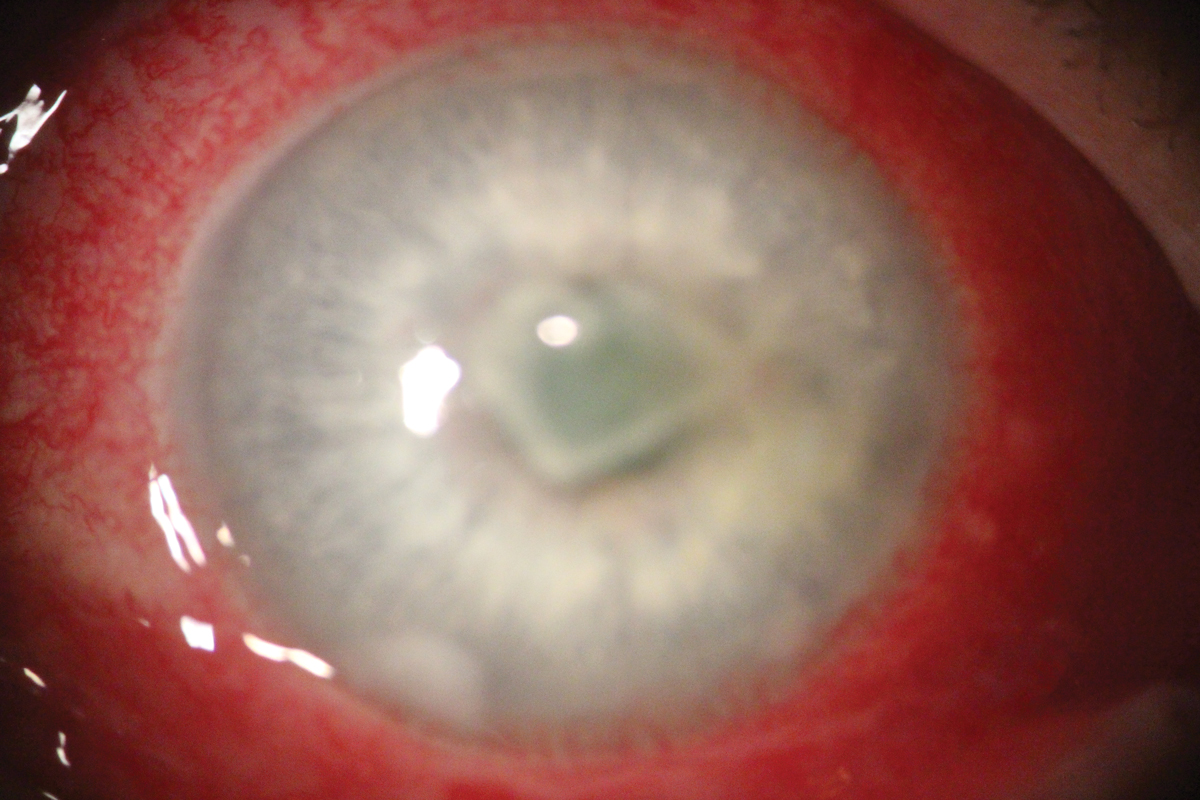Fig. 2. Non-MRSA Staph. aureus corneal ulcer.
