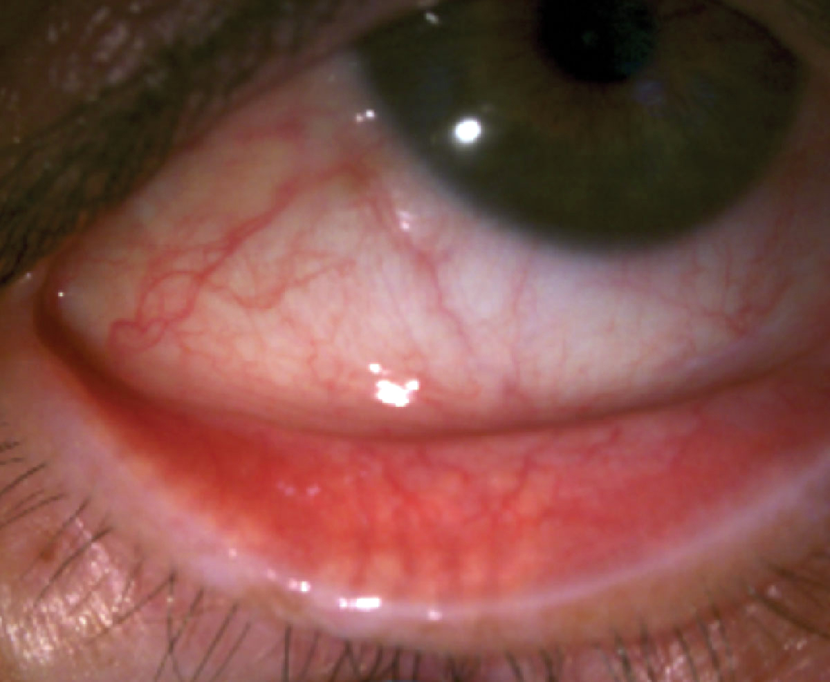 Eyelid vascularity, the sign most closely associated with inflammation in this study, is also the MGD sign most closely linked with rosacea, a condition presenting with erythema, papules and telangiectasias in the facial skin.