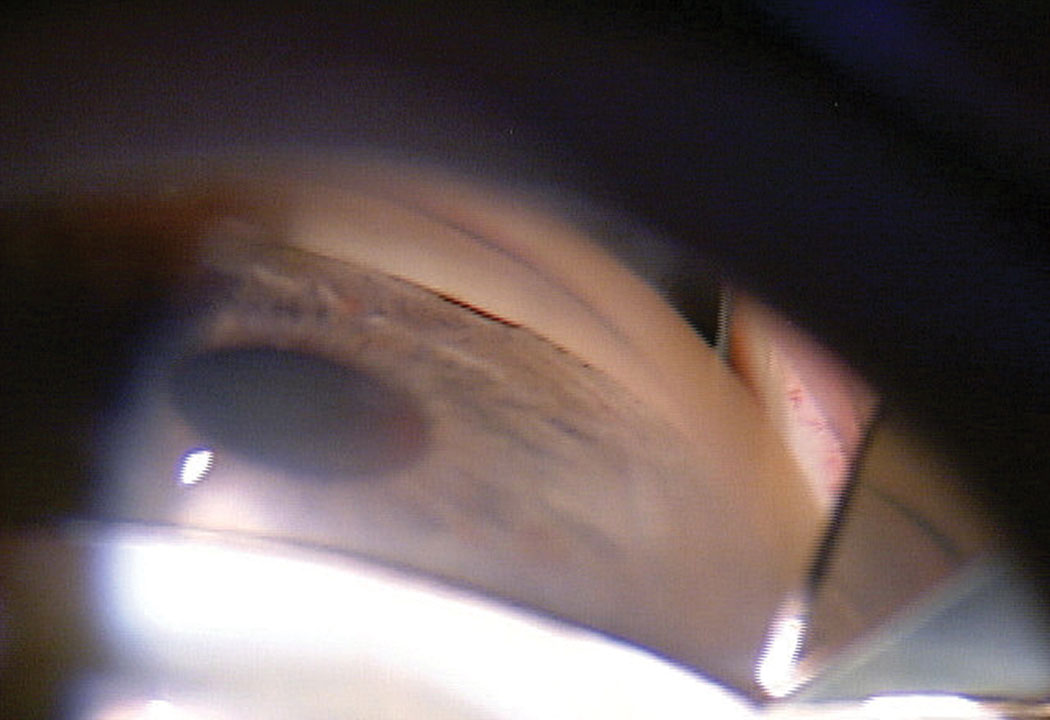 Researchers noted in their study that performing phaco surgery for primary angle closure glaucoma has its risks, since the anterior chamber is shallow and there is a lack of muscle tone in the pupil. However, their findings along with the trials reviewed in this study have supported the safety and efficacy of phaco over laser peripheral iridotomy.