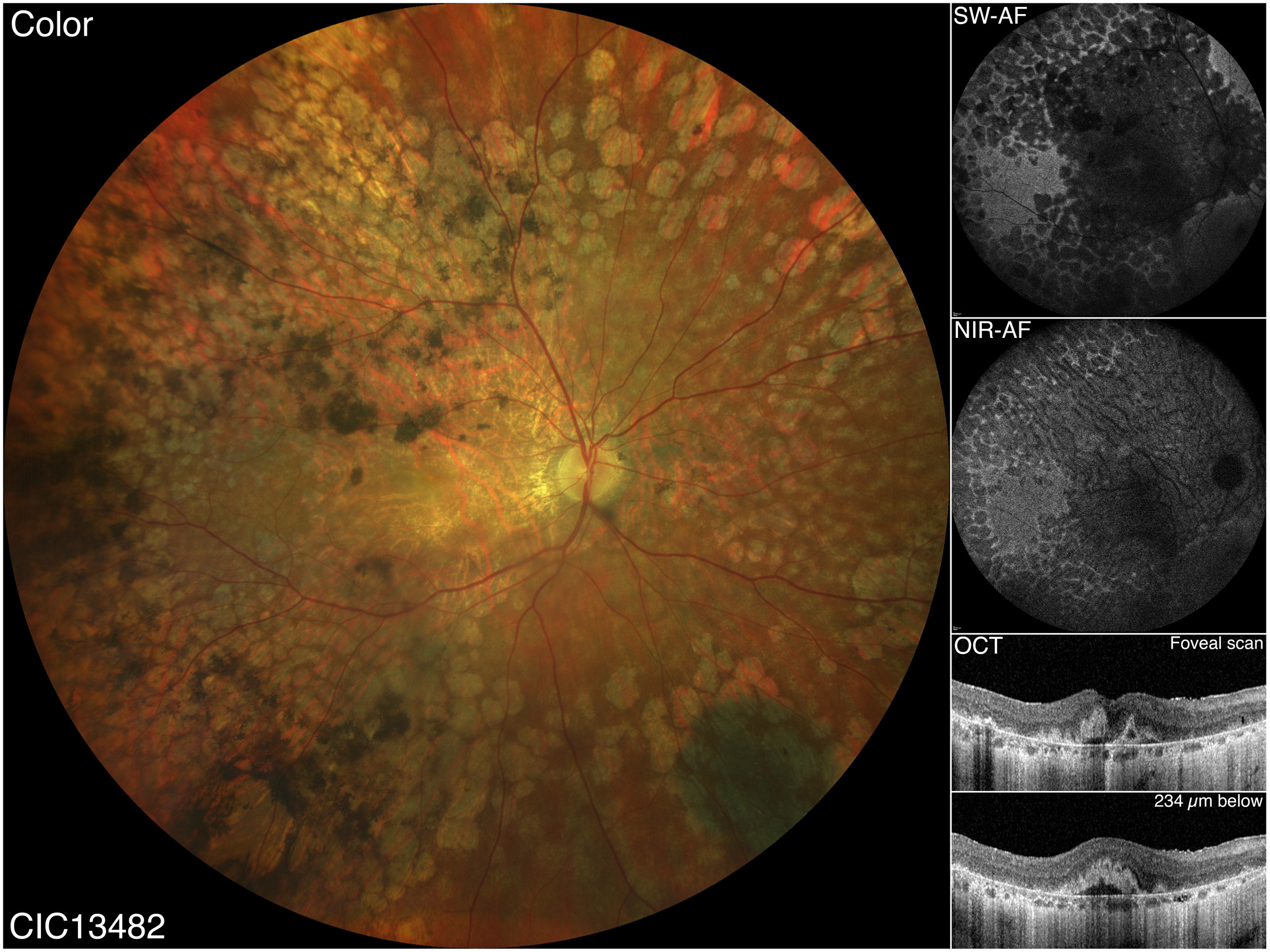 EMAP remains an underrecognized condition, especially among the elderly, who are more likely to be misdiagnosed with AMD. Earlier onset, more rapid progression of atrophy, and severe visual loss were noted in the former in contrast to the latter condition. The multimodal imaging of advanced EMAP above (from the study) exhibits a diffuse retinal involvement with “confluent” pavingstone-like degeneration merging with the extensive macular atrophy. OCT reveals large hyperreflective pyramidal structures within the atrophic fovea that are not clearly visible on color fundus photograph. 