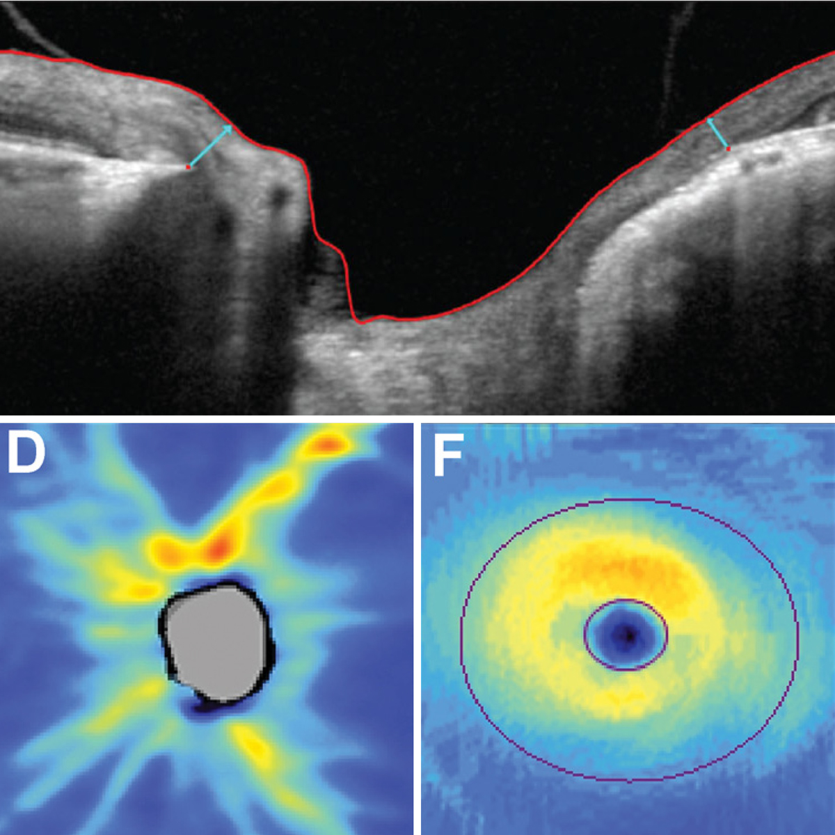 RNFLT may be more useful than MRW in early glaucoma assessment because of its previously reported lower variability and reduced sensitivity to intraocular pressure changes.