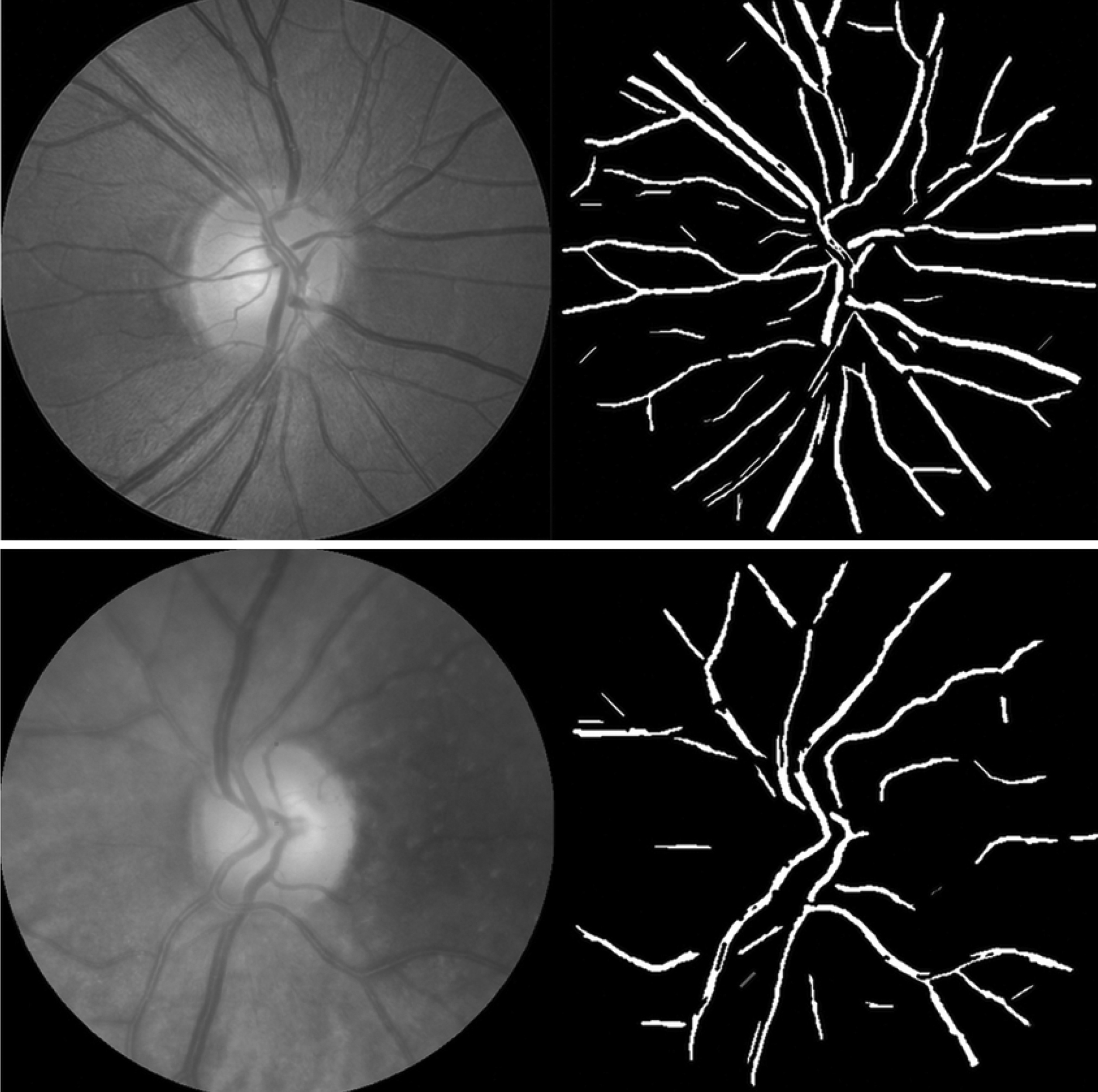 A metric called retinal fractal dimension, relating to the complexity of the retinal vasculature, may have a future role in screenings for systemic diseases. These photos show patients with high (top image) and low (bottom image) fractal dimension.