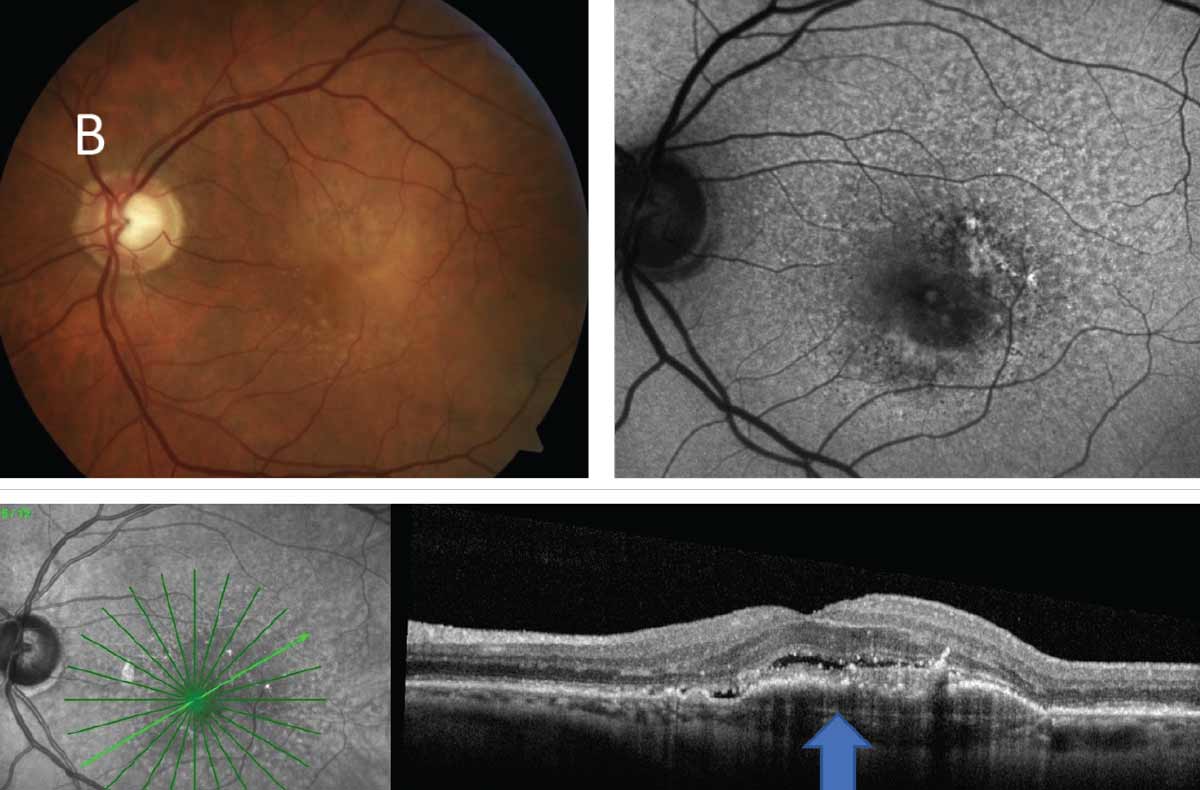 Using home-monitoring vision tests to evaluate disease activity in neovascular AMD could cause active lesions to be missed, as this modality failed to demonstrate satisfactory diagnostic accuracy in a new study.