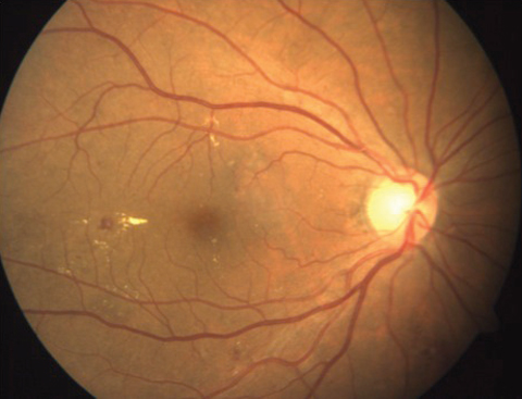 Teleretinal screening is an effective approach to DR screening not only for its accuracy in detecting disease but also for improving screening compliance in a cost-effective manner. This approach was not, however, as effective in detecting DME.