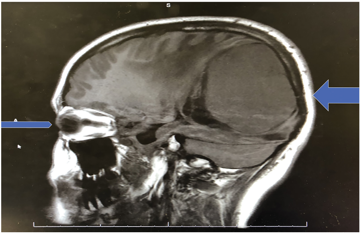 Fig. 2. This sagittal MRI images both the right eye and the parietal-occipital mass. Note the size of the mass relative to the size of the globe.