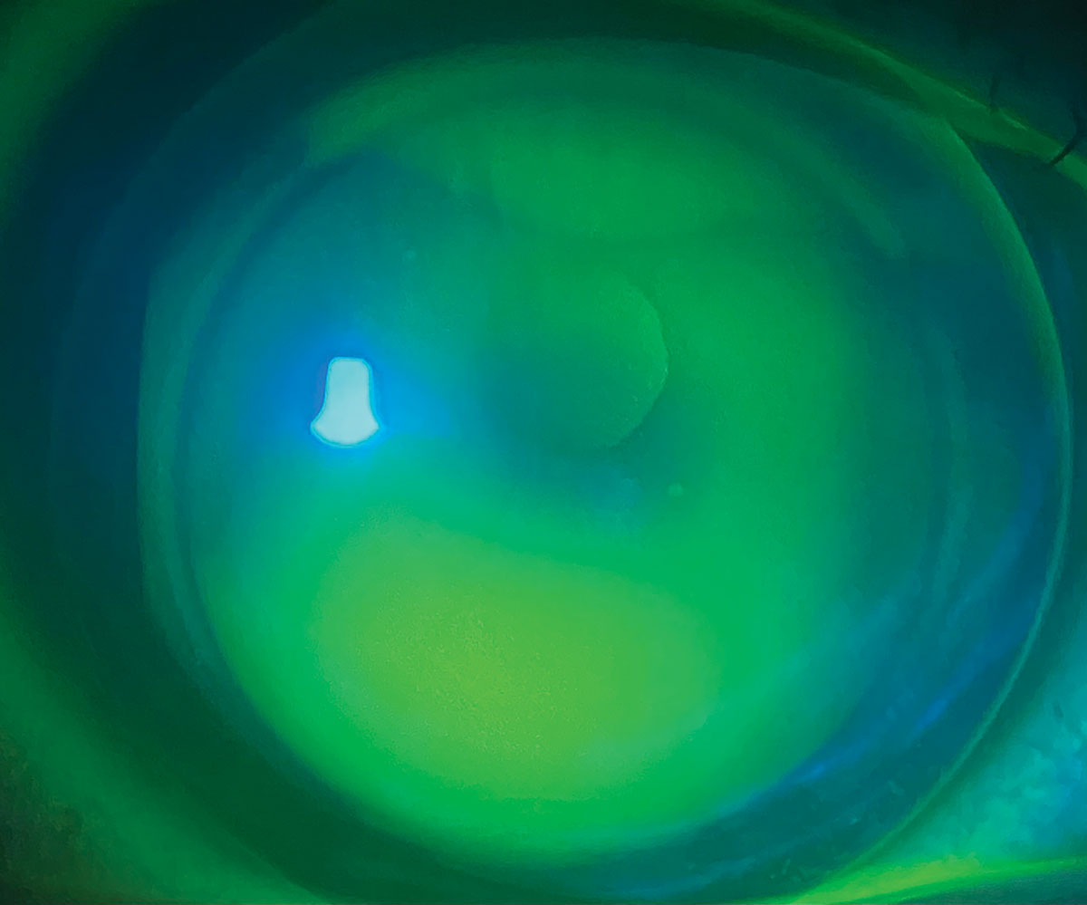 Fig. 4. Keratoconus managed with gas permeable contact lens.
