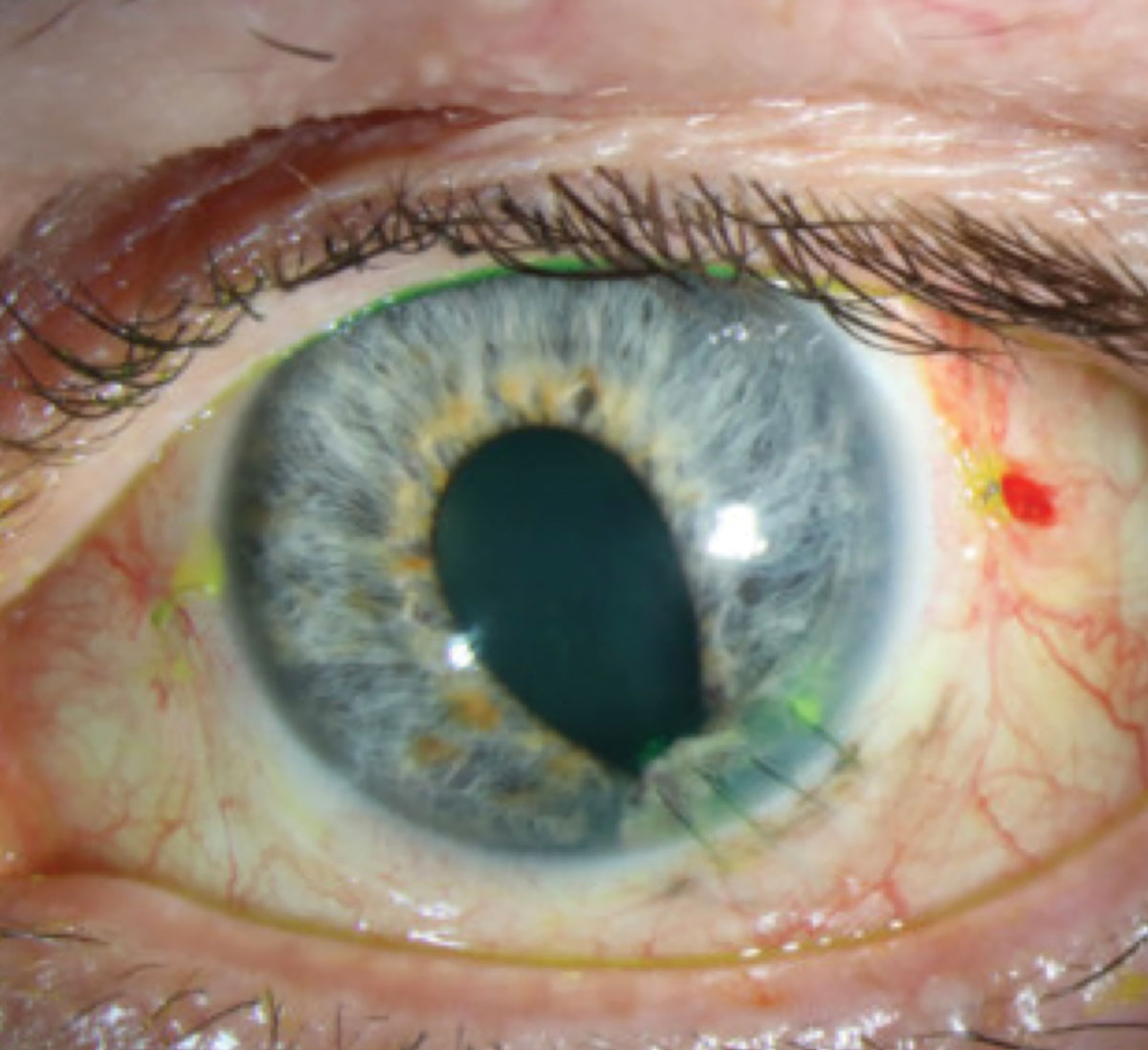 Fig. 5. Status post-repair of penetrating corneal injury with perforation.