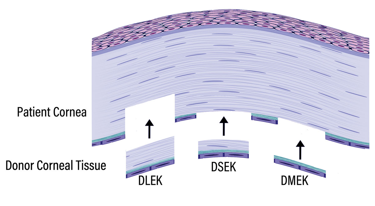 Fig. 1. Schematic illustrating the relative thickness and layers of recipient tissue removed and donor tissue implanted in successive iterations of EK known as DLEK, DSEK and DMEK. Note that DLEK includes removal of recipient posterior stroma, Descemet’s membrane and endothelium whereas only the central host Descemet’s membrane and endothelium are removed in DSEK and DMEK.