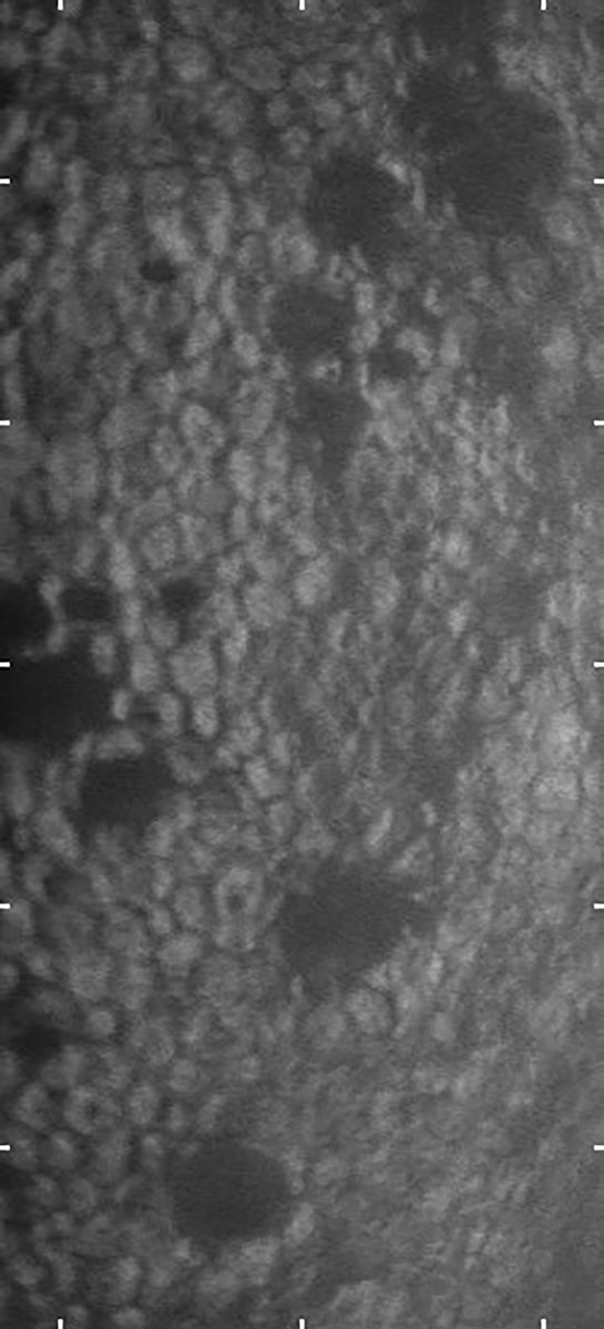 Fig. 2. Specular microscopy image of the corneal endothelium in a patient with early Fuchs’ dystrophy. The dark areas are the characteristic guttae associated with endothelial cell drop out.