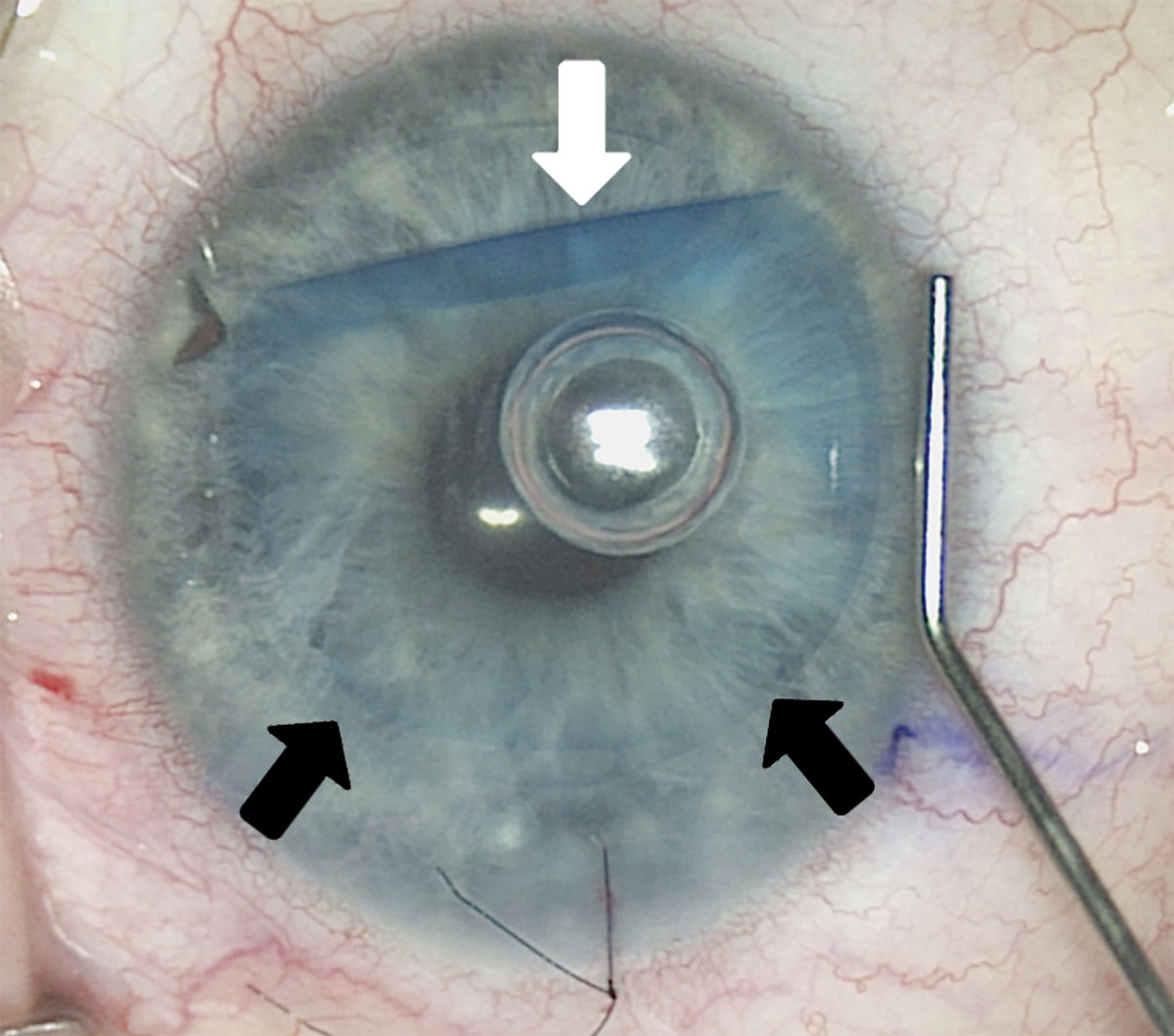 Fig. 3. This intraoperative image shows placement of DMEK donor tissue in a recipient eye. The DMEK tissue, which is approximately 20µm thick, was stained with trypan to facilitate visualization. The tissue was folded for insertion through a 2.2mm incision, and is being uncurled inside the eye using tapping maneuvers on the surface of the host cornea. A small air bubble was injected beneath the DMEK tissue to help it stay uncurled and pressed against the host cornea. The black arrows show the thin edge of the graft where it is fully uncurled and the white arrow shows an edge that is still curled.