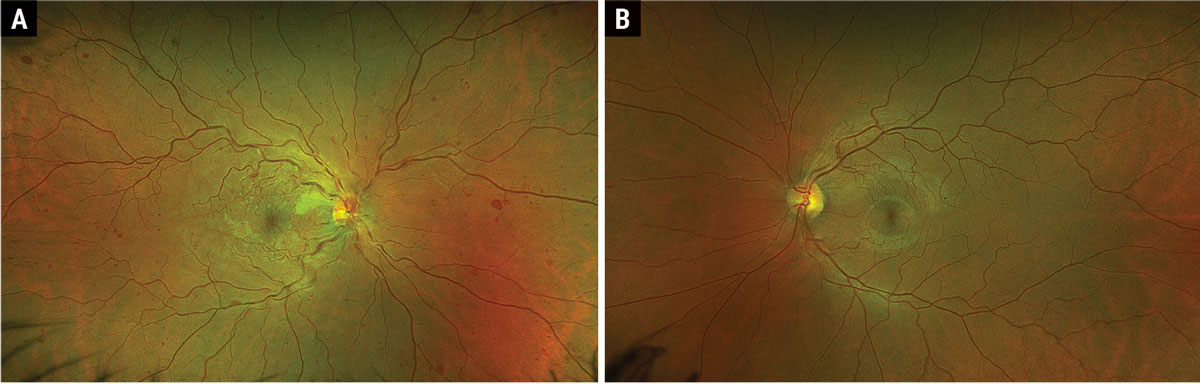 Fig. 1. Optos ultrawidefield fundus photograph of OD (A) and OS (B).